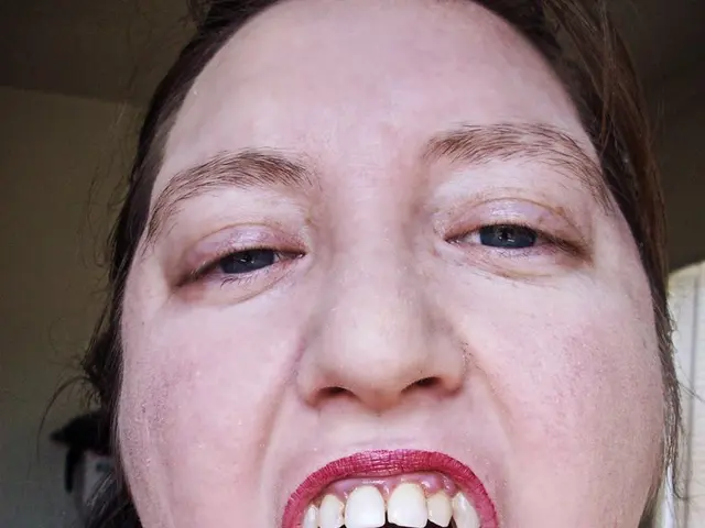 Lip augmentation trend: Enhanced volume potentially compromising sensation?