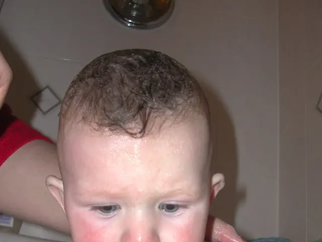 Hydrocephalus: An Explanation of This Brain Disorder